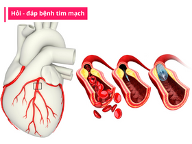 Bệnh cầu cơ mạch vành tim khi nào cần can thiệp?